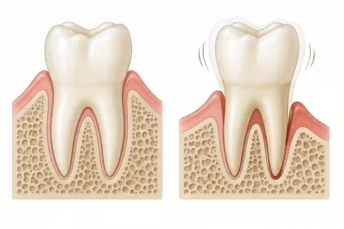 Comparación del soporte de un diente firme y un diente con movilidad periodontal Comparación del soporte de un diente firme y un diente con movilidad periodontal