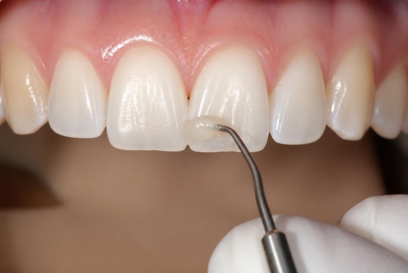 Restauración con resina estética en un diente anterior superior durante el tratamiento en consulta