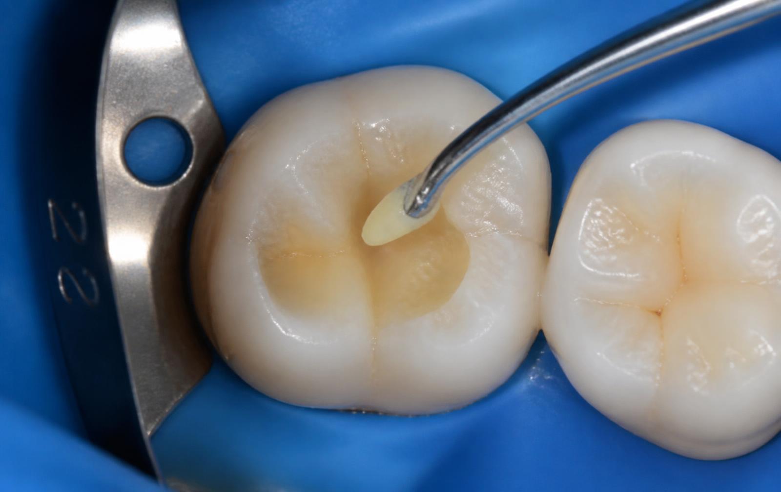 Restauración dental con resina en la superficie masticatoria de una muela después de tratar una caries